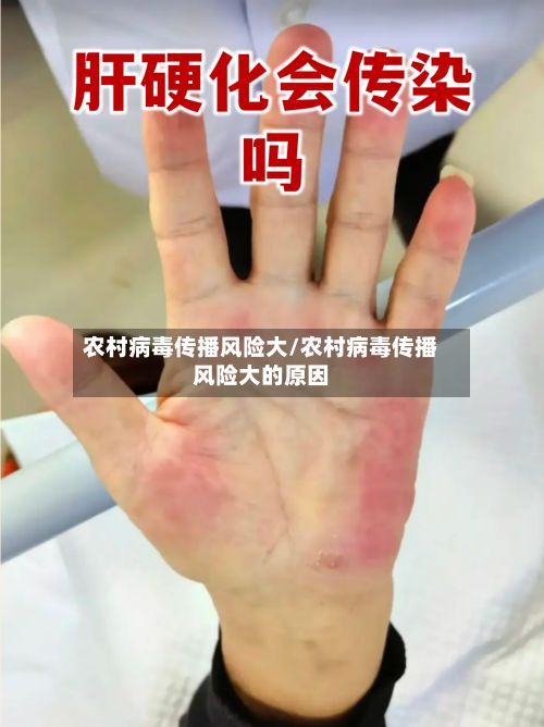 农村病毒传播风险大/农村病毒传播风险大的原因
